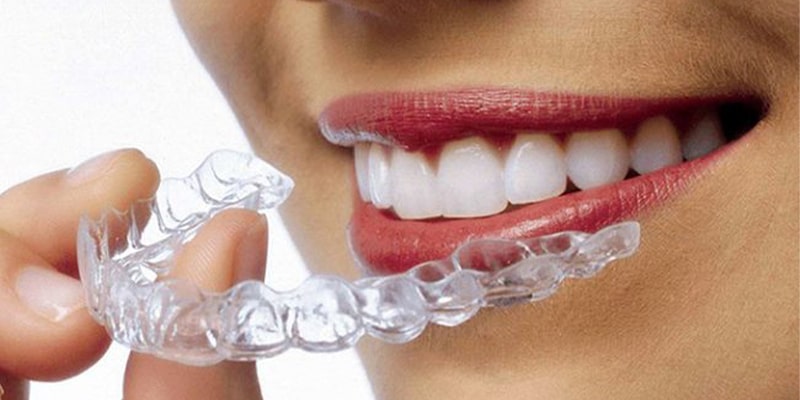 Invisible orthodontics
