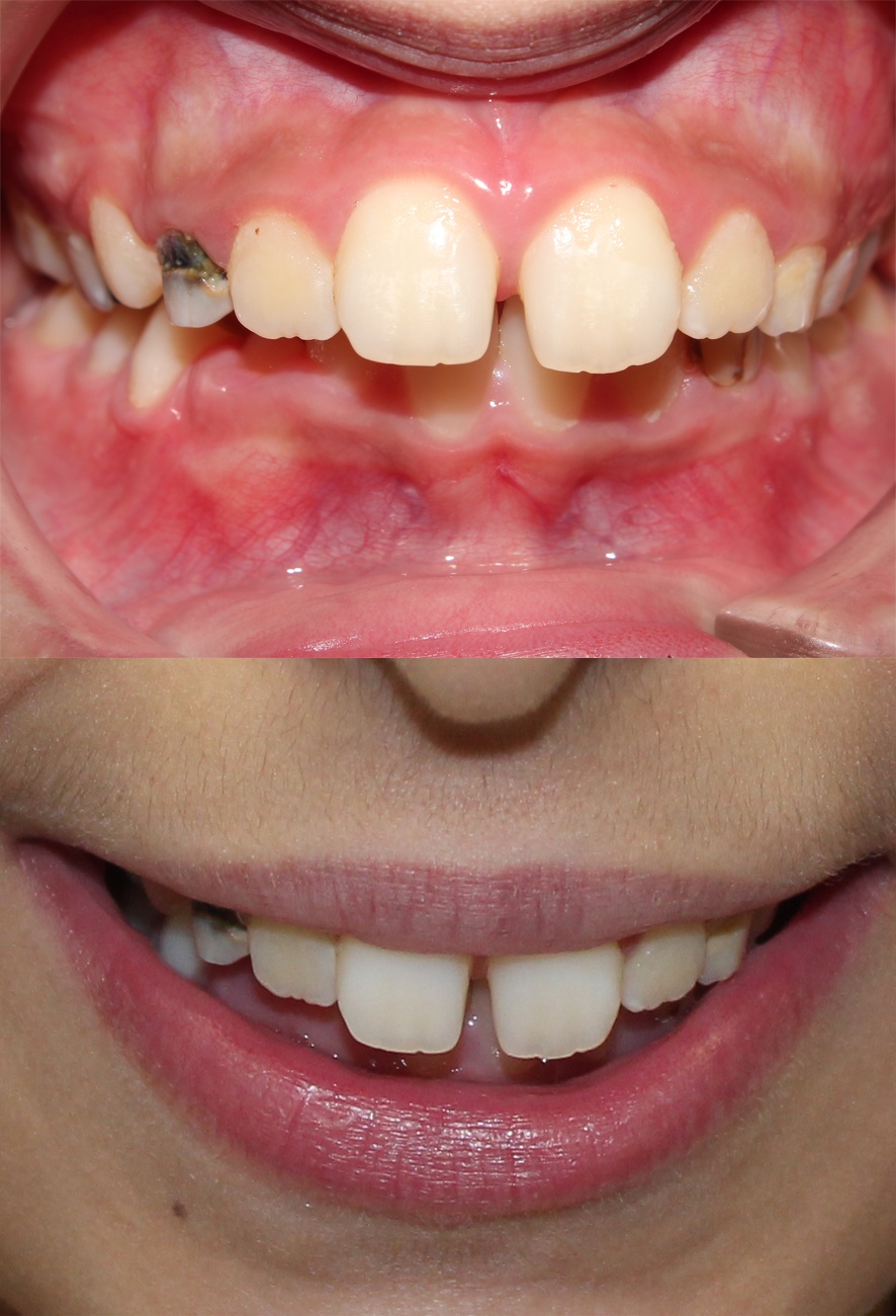 helia before